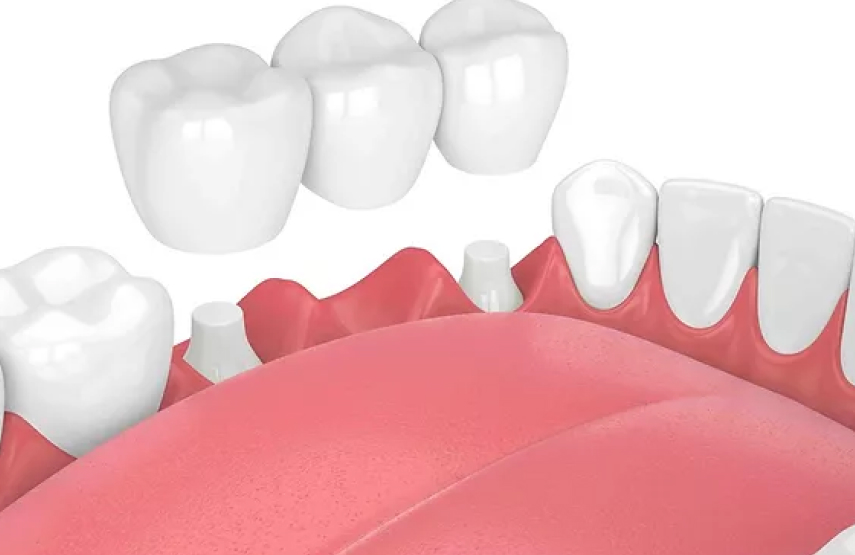 Dental Crown/Bridge