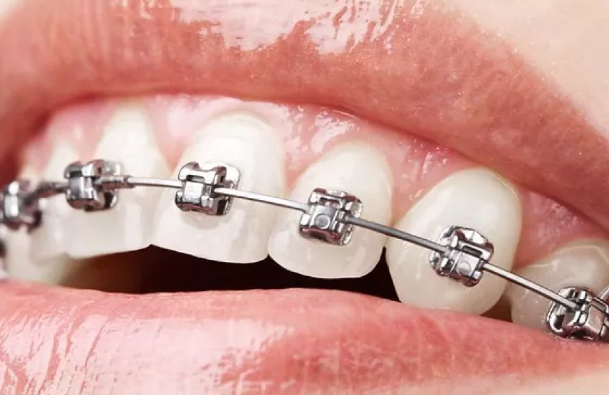 Orthodontic (Self-Ligating)