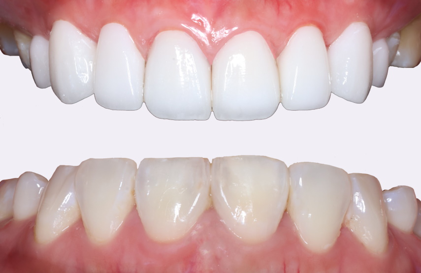 Porcelain Veneers