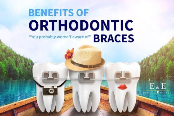 Benefits of Orthodontic braces